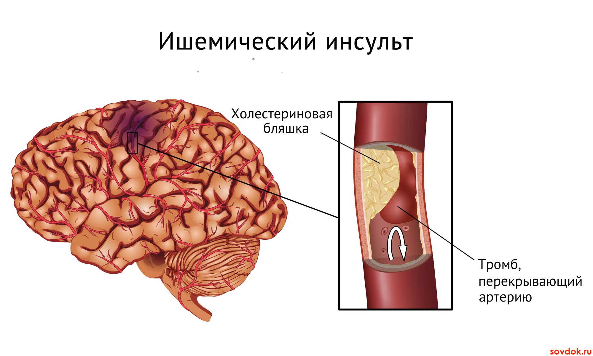ишемический инсульт