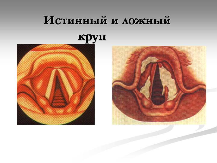 Истинный и ложный круп
