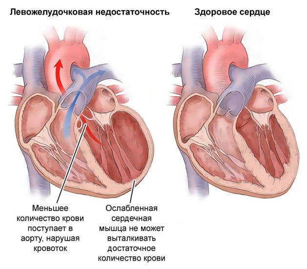 К левожелудочковой недостаточности приводят сердечные патологии: миокардит, кардиомиопатия и пороки.