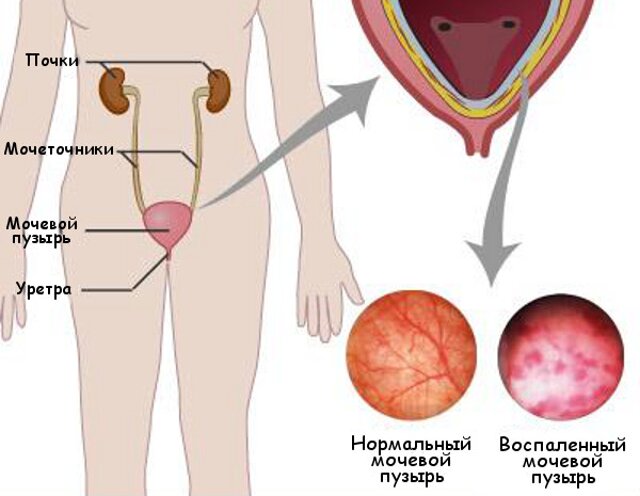 Как выглядит цистит у мужчин