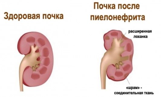 Как выглядит пиелонефрит