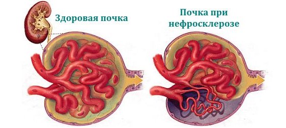 Какие изменения происходят при нефросклерозе с почкой
