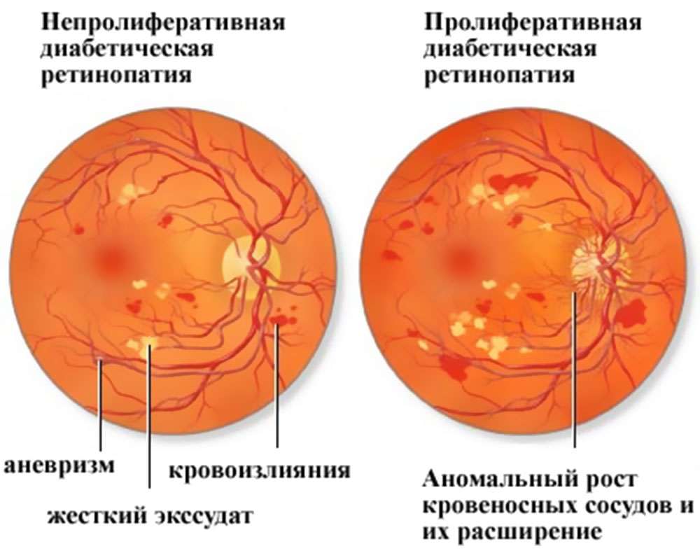 Картина глазного дна при диабете