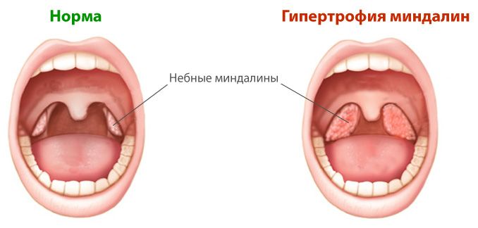 увеличенные миндалины