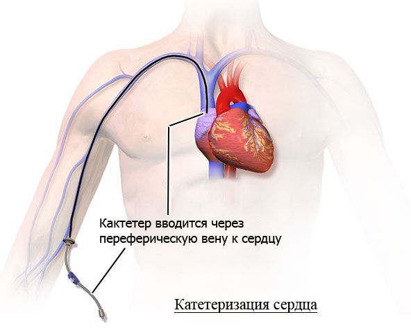 Катетеризация сердца