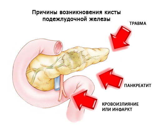 Что такое киста на поджелудочной железе, чем она опасна и как ее лечить