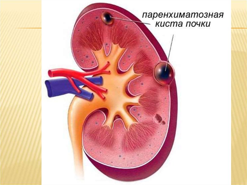 Киста почки