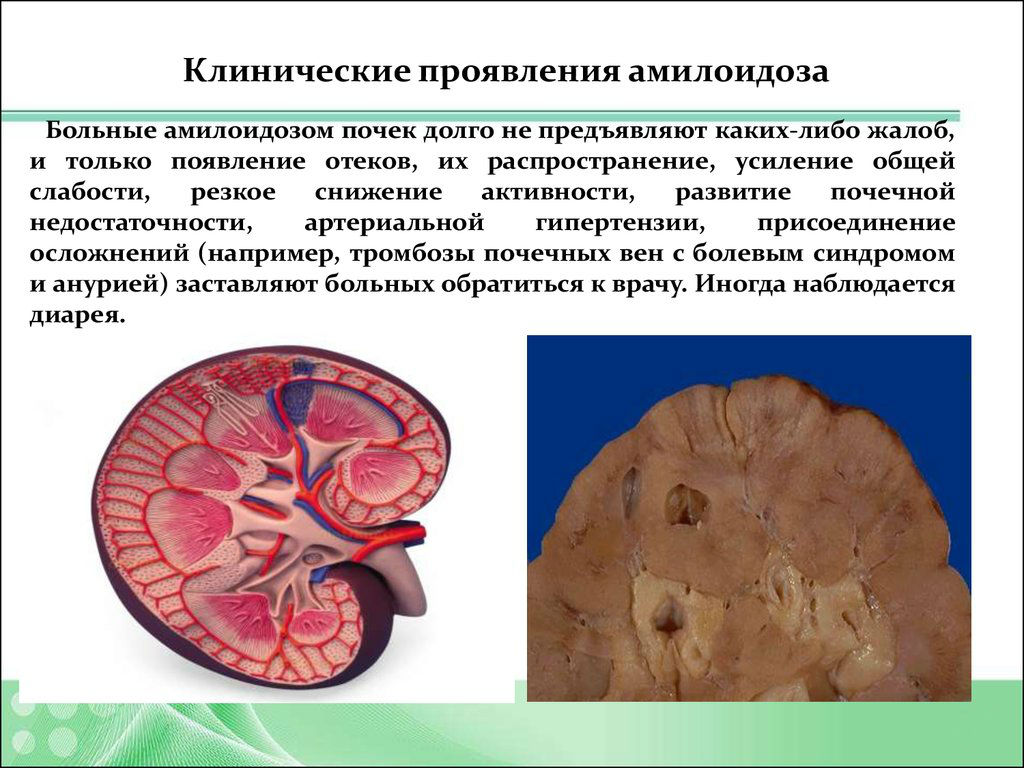 Клинические проявления амилоидоза