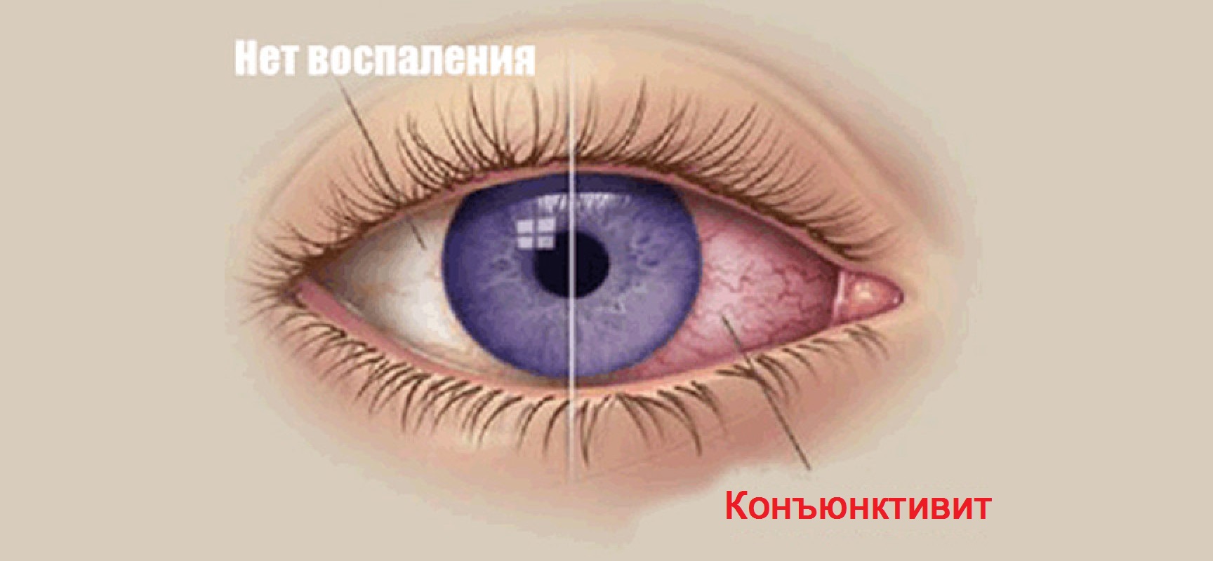 конъюнктивит схема