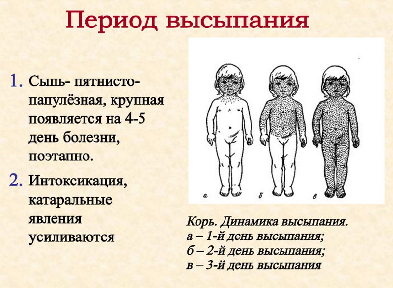 Корь: период высыпания