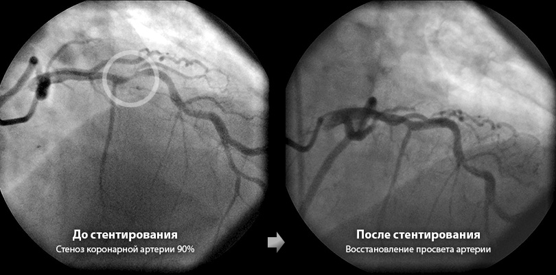 Ангиопластика и стентирование