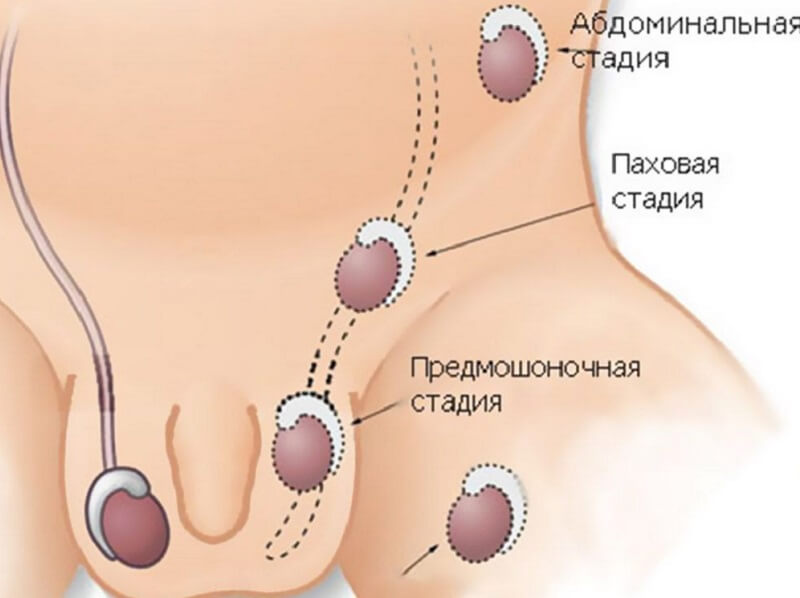 Крипторхизм