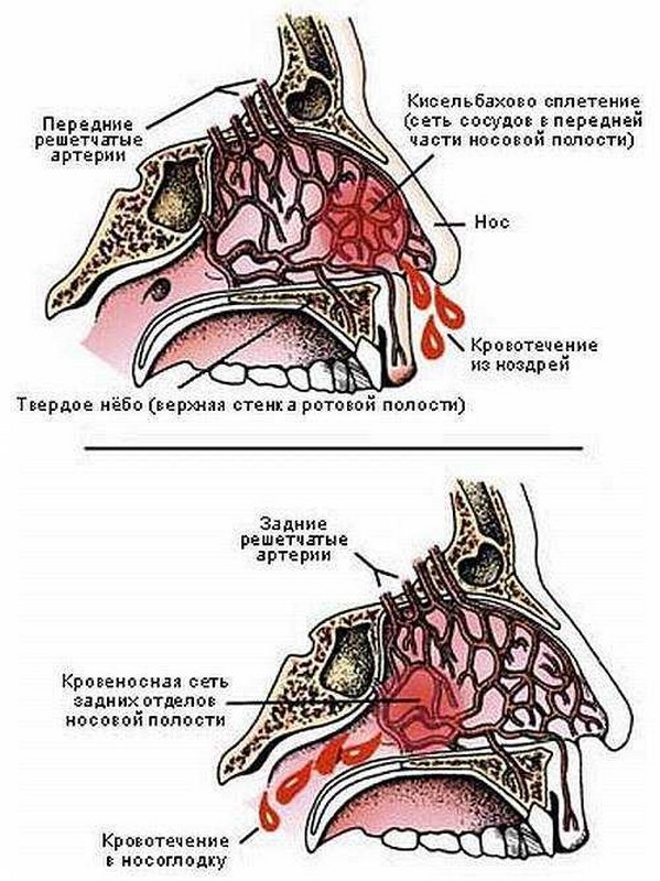 Схематическое изображение переднего и заднего кровотечения