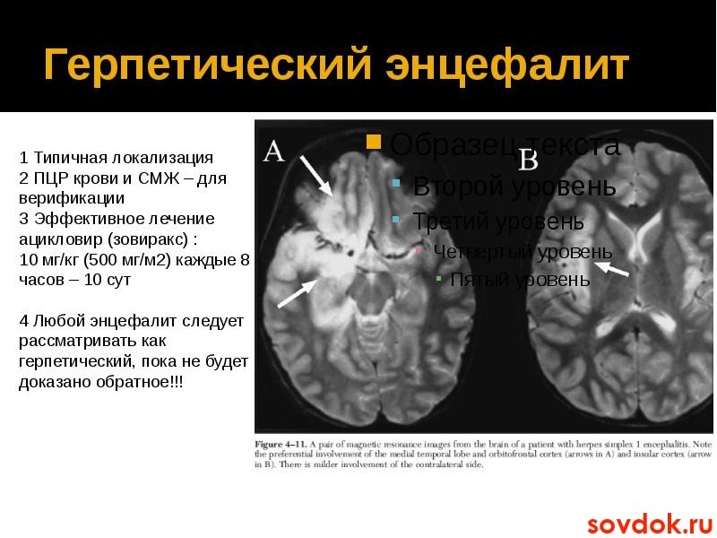 кт герпетического энцефалита