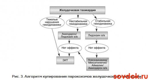 купирование пароксизмов ЖТ