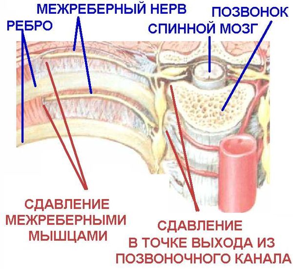 Причины межрёберной невралгии — схема