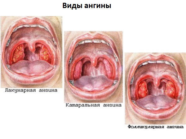 виды ангина