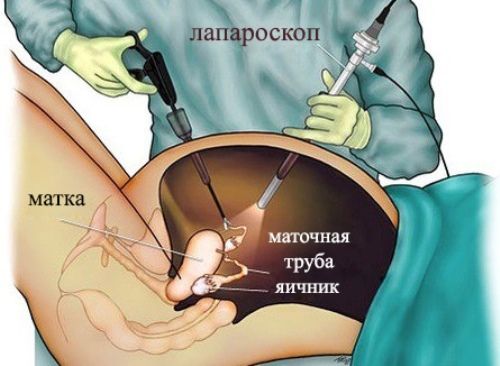 Лапароскопическая операция