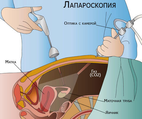 Лапароскопия