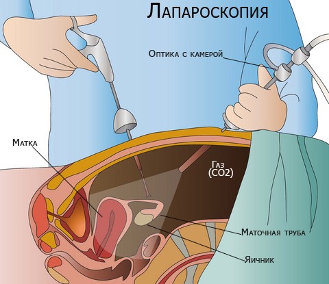 Лапароскопия