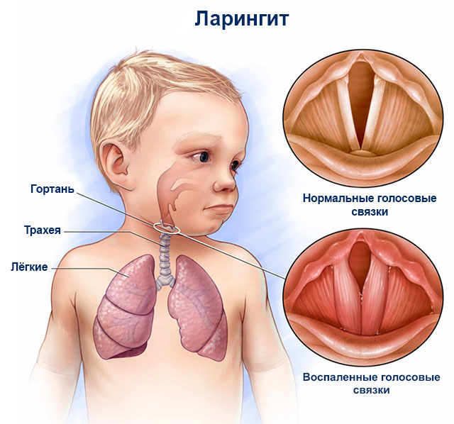 схема ларингита