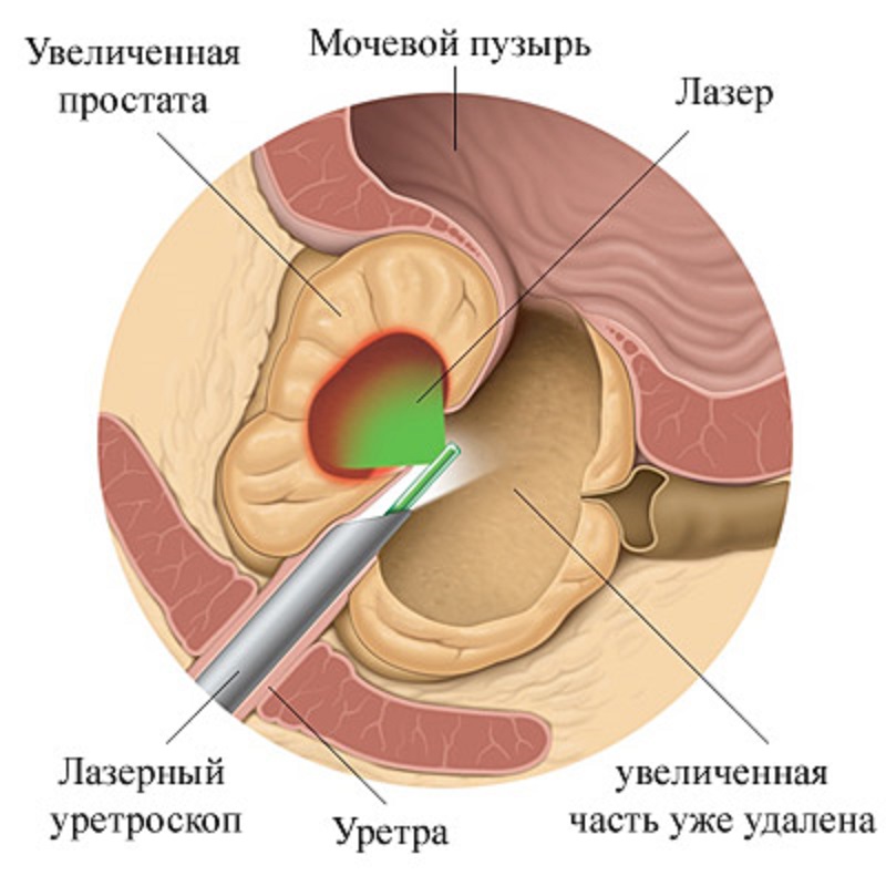 лазерная энуклеация