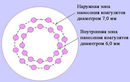 Лазерная термокератопластика