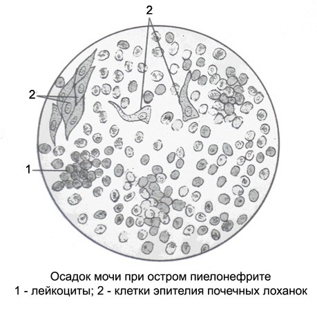 Лейкоциты в осадке мочи