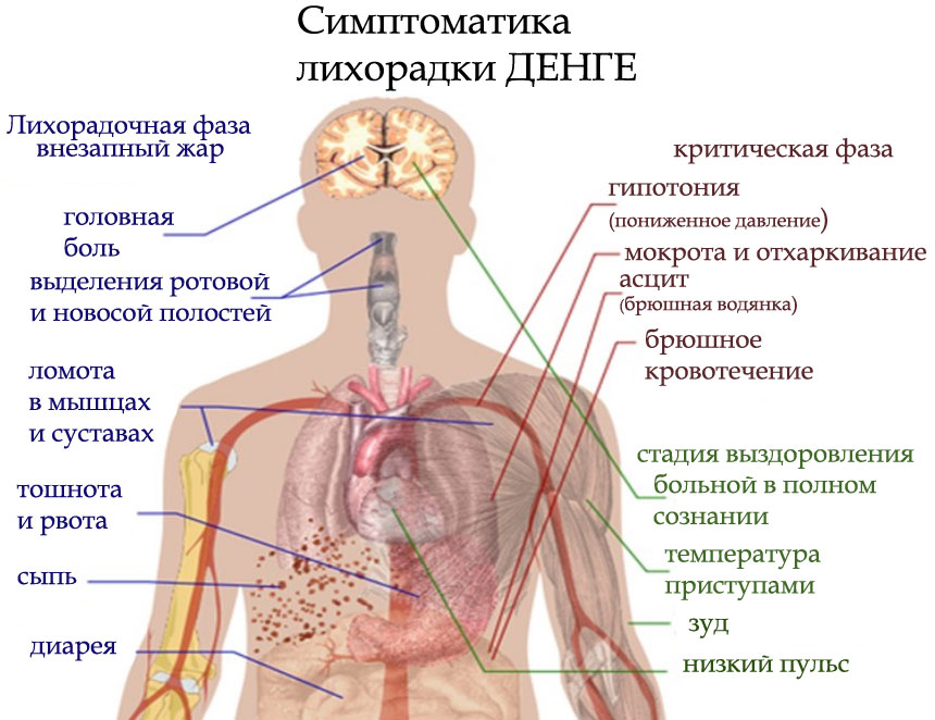 Симптомы лихорадки Денге