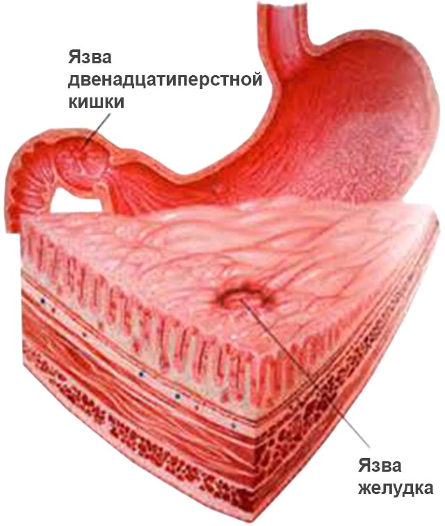 Локализация язвы желудка
