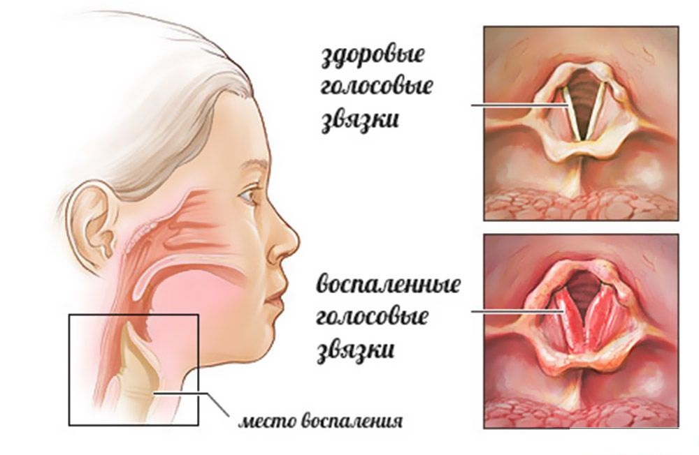Ларингит: здоровые и воспалённые голосовые связки