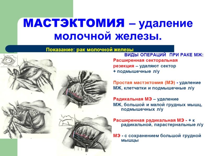 мастэктомия