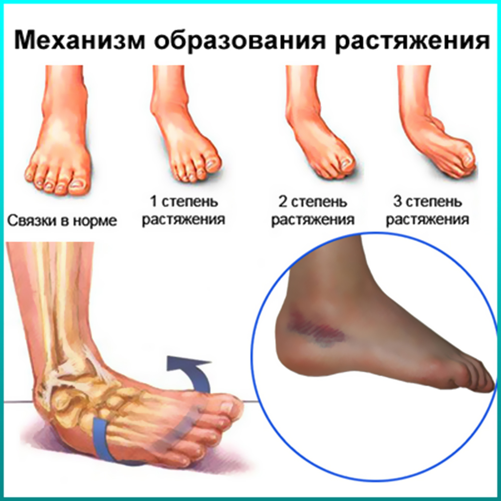 Механизм растяжения связок на примере голеностопа