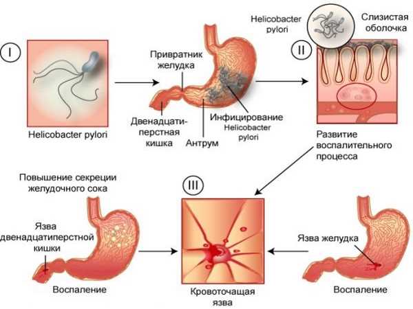 Механизм развития язвы желудка