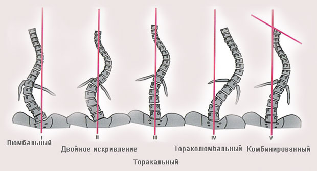 Местоположение искривления
