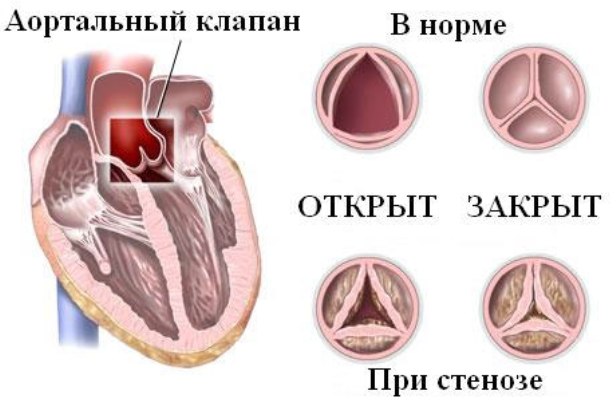 Митральный стеноз