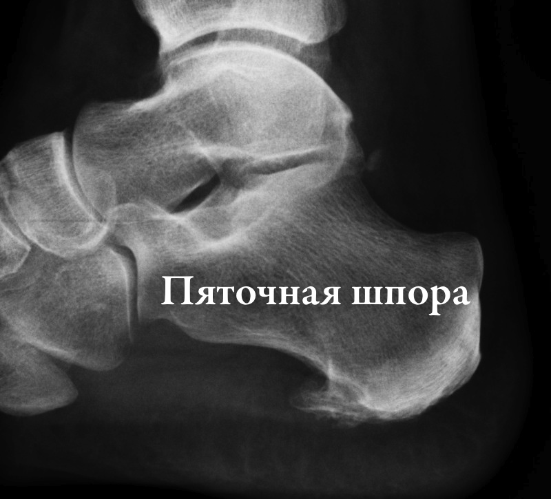 рентгенограмма пяточной шпоры
