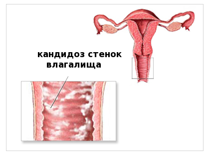 Молочница