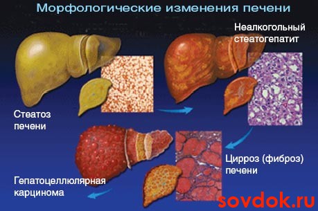 морфологические изменения печени