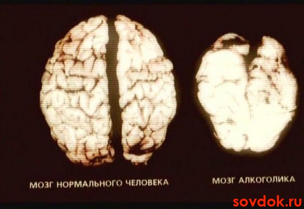 мозг нормального и алкоголика