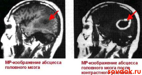 мрт абсцесса гм