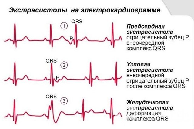 На фото показатели ЭКГ с экстрасистолической тахикардией