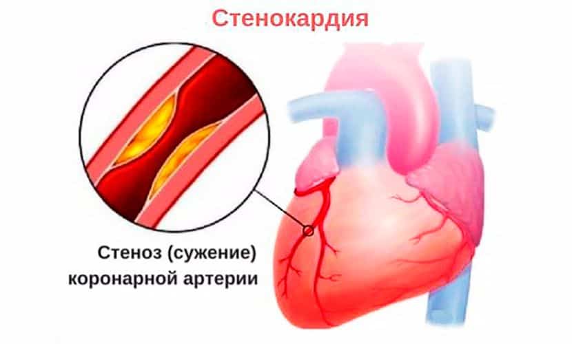 На фото сужение просвета артерии, которое влечет стенокардию и некроз тканей сердца.
