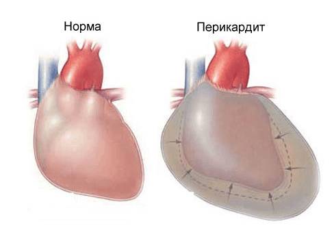 На фото видно, как выглядит перикадит