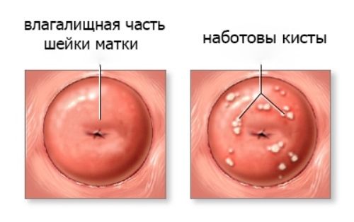 Наботовы кисты