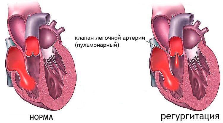 Недостаточность клапана при регуритации легочной артерии