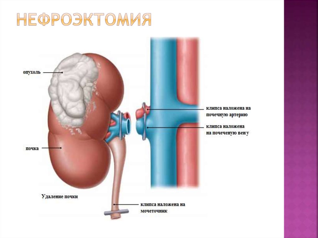 Нефроэктомия