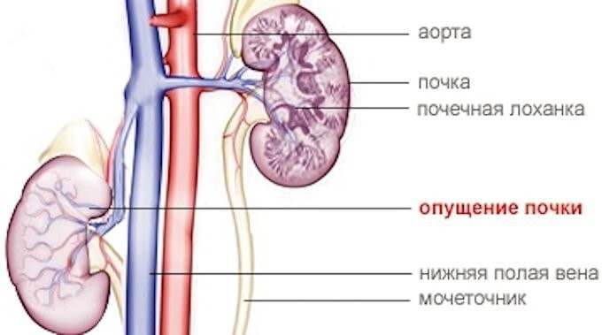 Нефроптоз