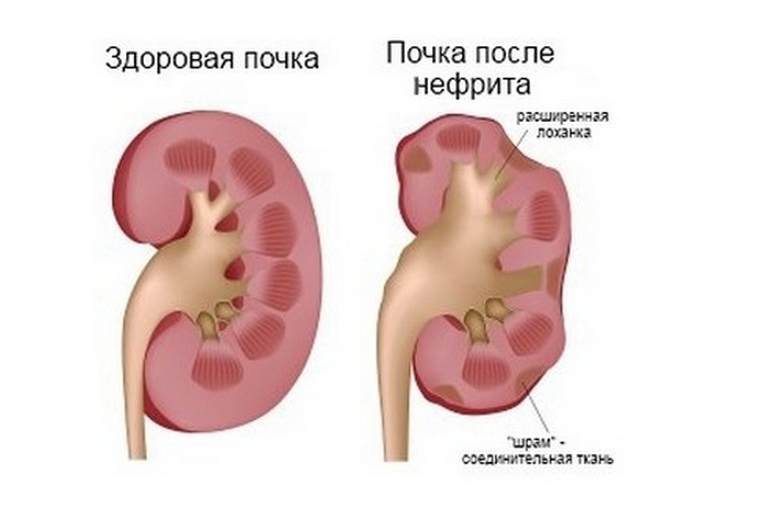 Здоровая почка и после перенесённого воспаления