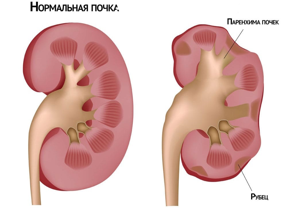 Нормальная почка и почка при нефрите
